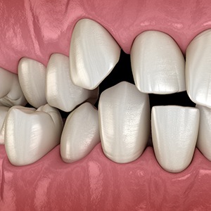 Illustration of misaligned teeth