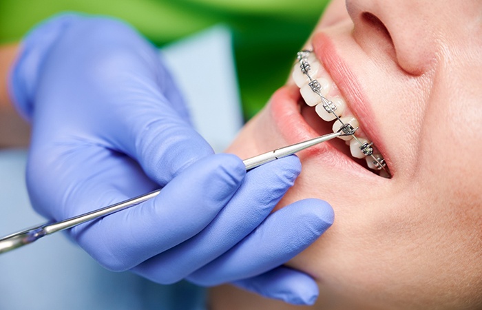 Gloved hand placing bands on someone’s braces
