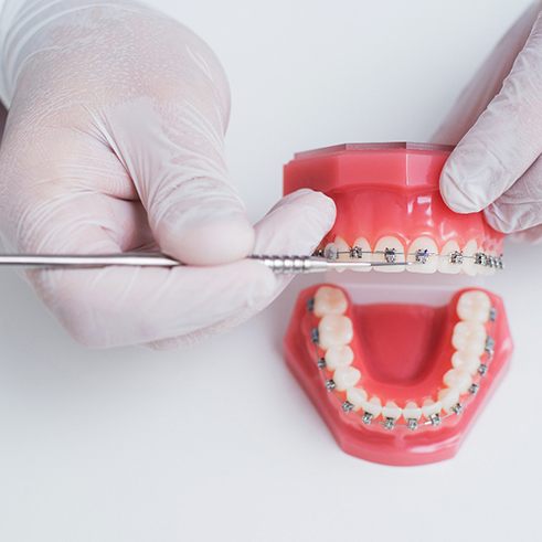 Gloved hands showing off braces on model teeth