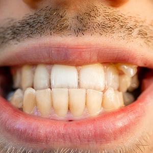 Closeup of man’s underbite