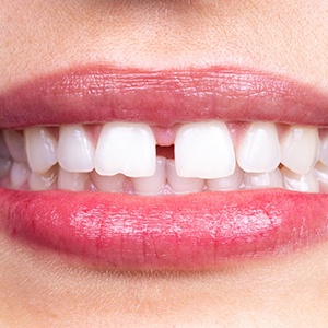Closeup of smile with diastema